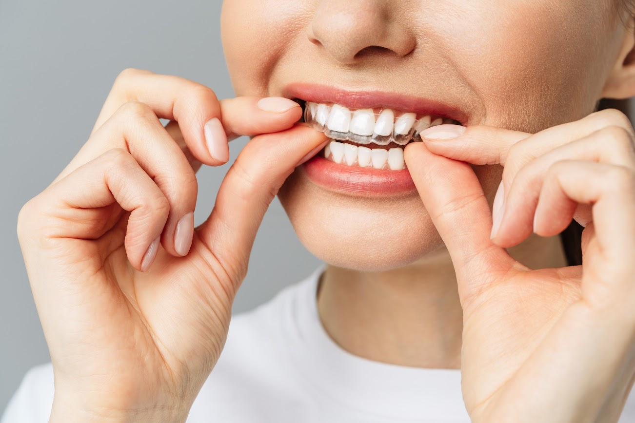 Braces and Clear Aligners in Houston